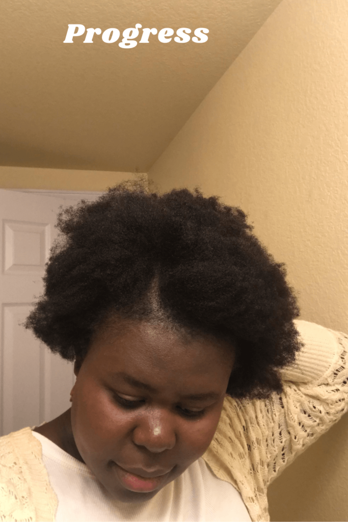 postpartum hair loss treatment
